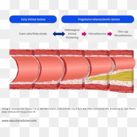 Atherosclerotic Lesion Development - Atherosclerosis Lesions, HD Png Download - blood streak png