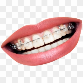 Transparent Mouth With Braces, HD Png Download - mouth png