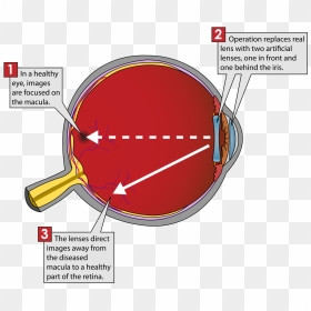 Implantable Miniature Telescope Diagram, HD Png Download - red eye lens png