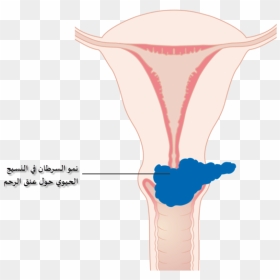 Diagram Showing Stage 2b Cervical Cancer Cruk 216-ar - Cervical Cancer, HD Png Download - ar png