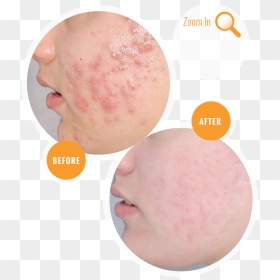 Acne Before And After Treatment - Acne Before And After, HD Png Download - acne png
