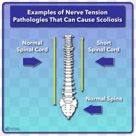 Functional Vs Structural Scoliosis Xray, HD Png Download - spinal cord png