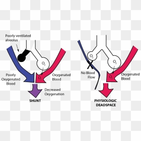 Imbalance Between Perfusion And Ventilation Is Called - Pulmonary Shunt, HD Png Download - dead space logo png