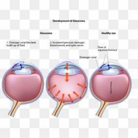 Glacoma-opacity - Development Of Glaucoma, HD Png Download - closed eyes png