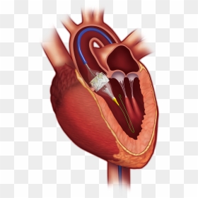 Balloon Aortic Valvuloplasty Vs Tavr, HD Png Download - twiiter png