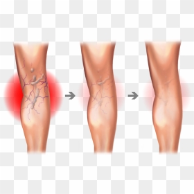 Spider And Varicose Vein Treatment Center - Varicose Veins Hd, HD Png Download - vein png