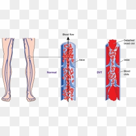 What Is Deep Vein Thrombosis - Deep Vein Thrombosis Diagram, HD Png Download - vein png