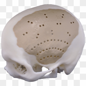 Peek Cranial Implant, HD Png Download - chrome skull png