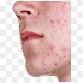Close Up Of Acne On Man"s Chin - Bcaa Side Effects, HD Png Download - pimple png