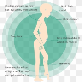 Foot Drop Fshd, HD Png Download - muscle arms png