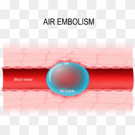 Air Embolisms, HD Png Download - air bubbles png