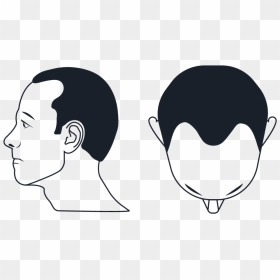 Hair Loss Chart Graphic Male Balding Patterns - Hair Loss, HD Png Download - men hair only png