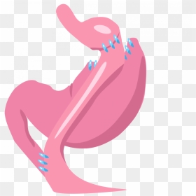 Gastric Bypass, HD Png Download - obesity png