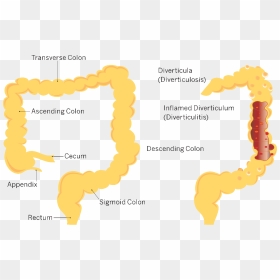 Diverticulitis Transparent , Png Download - Diverticulosis Icd 10, Png Download - colon png