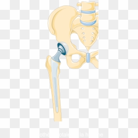 Total Hip Replacement Smart Servier - Illustration, HD Png Download - surgery png