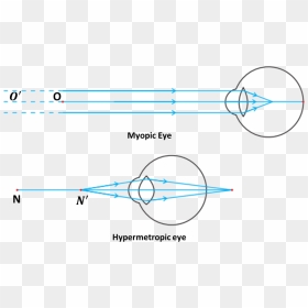 Image Myopic Eye And Hypermetropic Eye - Ray Diagram For Myopia, HD Png Download - human eye png