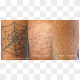 Cutera Enlighten Tattoo Removal, HD Png Download - spider web tattoo png