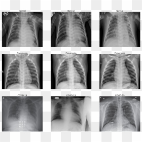 Normal Chest X Ray Vs Covid 19 Chest X Ray, HD Png Download - xray png