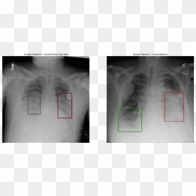 Detecting Pneumonia In X Ray, HD Png Download - xray png