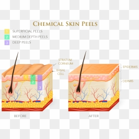 Infographic On Chemical Skin Peels - Layers Of Skin Chemical Peel, HD Png Download - scar texture png