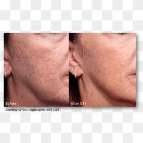 Genius Microneedling Acne Scars, HD Png Download - scar texture png