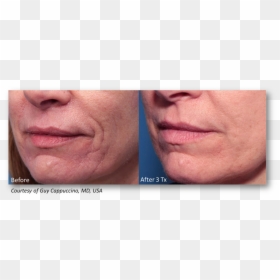 Microneedling Rf Before After Infini, HD Png Download - scar texture png