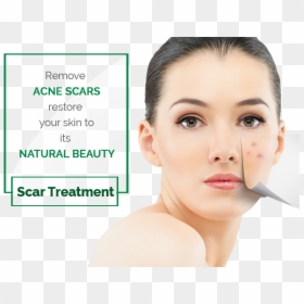 Mole Remover Pen, HD Png Download - scar texture png