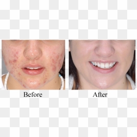 Transparent Face Scar Png - Microdermabrasion For Acne, Png Download - face scar png