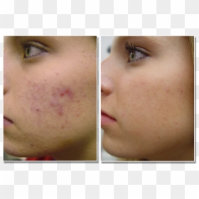 Acne Scarring - Does Acne Look Like At The Start, HD Png Download - face scar png
