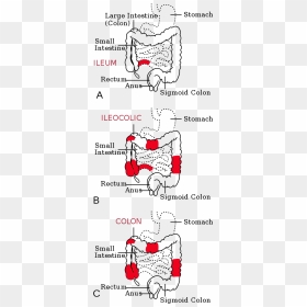Crohn's Disease 中文, HD Png Download - small intestine png