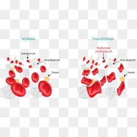 Thalassemia Blood Cells, HD Png Download - red blood cells png