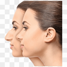 Modelos De Nariz Para Rinoplastia , Png Download - Nose Rhinoplasty, Transparent Png - nariz png