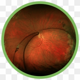 Complex Anterior Segment Disease - Fumari Tobacco Logo, HD Png Download - eye lens flare png
