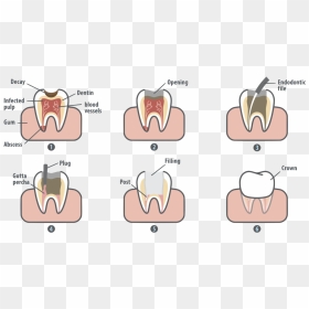 Tooth Clipart Crown Image Transparent Root Canal In - Root Canal Pain, HD Png Download - tooth.png