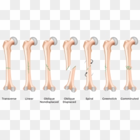 Types Of Fractures, HD Png Download - humans png