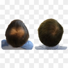 Fue Hair Transplant Scalp, HD Png Download - hair with bangs png