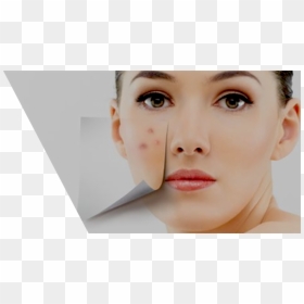 Acne, HD Png Download - face scar png