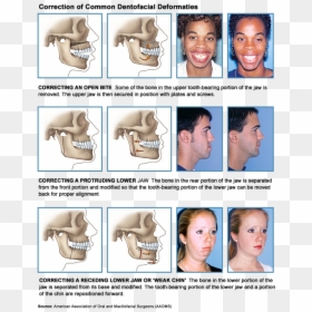 Jaw Alignment Surgery, HD Png Download - jaw png
